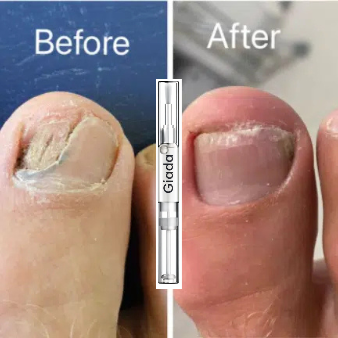 Anti Fungal Pen